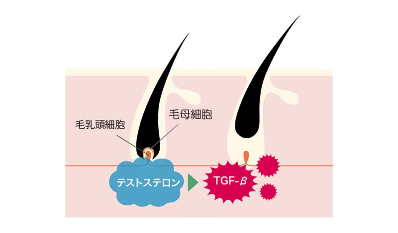 毛母細胞と毛乳頭細胞に影響を及ぼすテストステロン、TGF-β