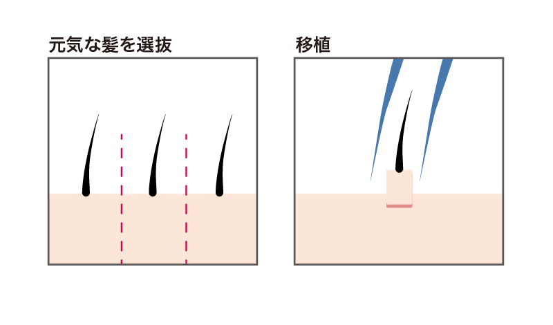 自毛を植毛する手術のイラスト