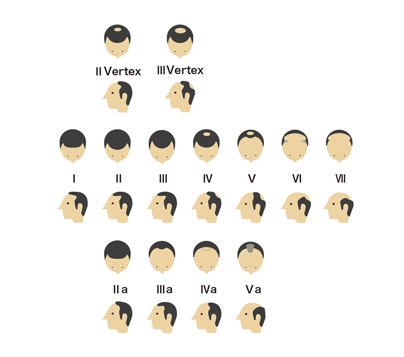 ハミルトン・ノーウッド分類