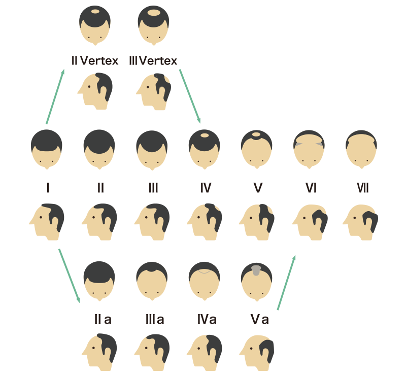 あなたの生え際はどの形 薄毛タイプから見る対策方法のススメ 髪コト 頭髪を通じてライフスタイルを豊かにするための情報を発信