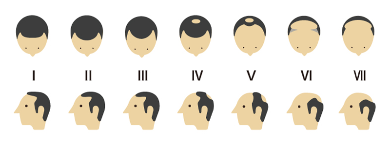 あなたの生え際はどの形 薄毛タイプから見る対策方法のススメ 髪コト 頭髪を通じてライフスタイルを豊かにするための情報を発信