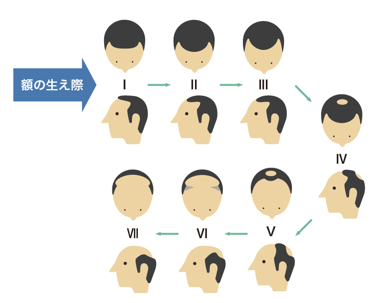 あなたの生え際はどの形 薄毛タイプから見る対策方法のススメ 髪コト 頭髪を通じてライフスタイルを豊かにするための情報を発信