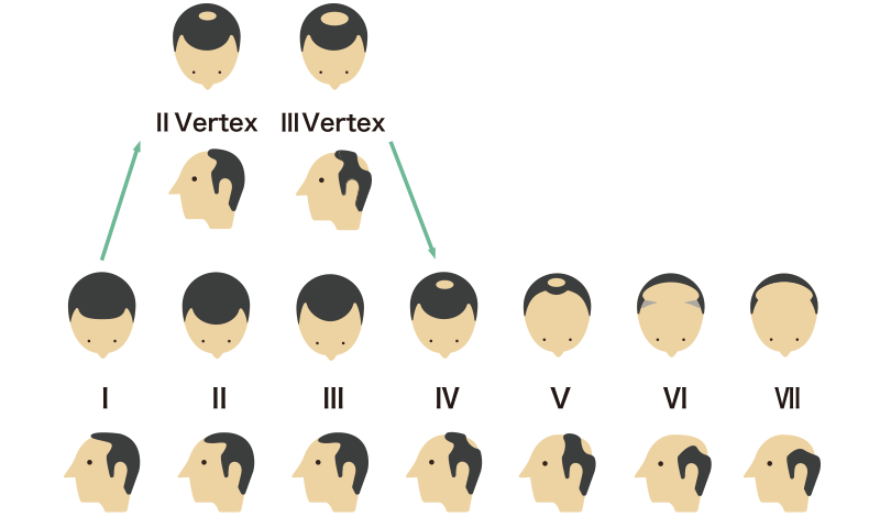 あなたの生え際はどの形 薄毛タイプから見る対策方法のススメ 髪コト 頭髪を通じてライフスタイルを豊かにするための情報を発信