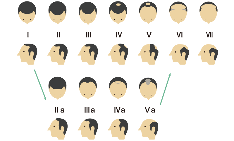 あなたの生え際はどの形 薄毛タイプから見る対策方法のススメ 髪コト 頭髪を通じてライフスタイルを豊かにするための情報を発信