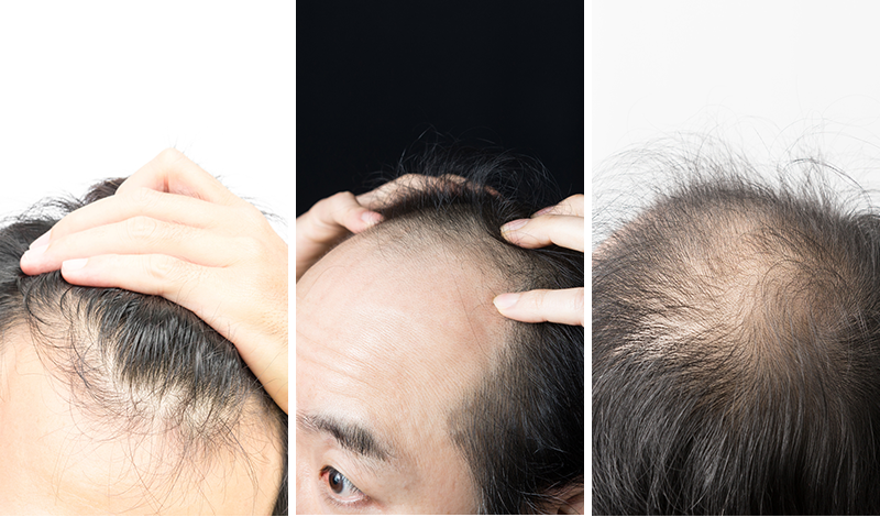 薄毛対策っていくつあるの 薄毛のタイプ別対策 髪コト 頭髪を通じてライフスタイルを豊かにするための情報を発信