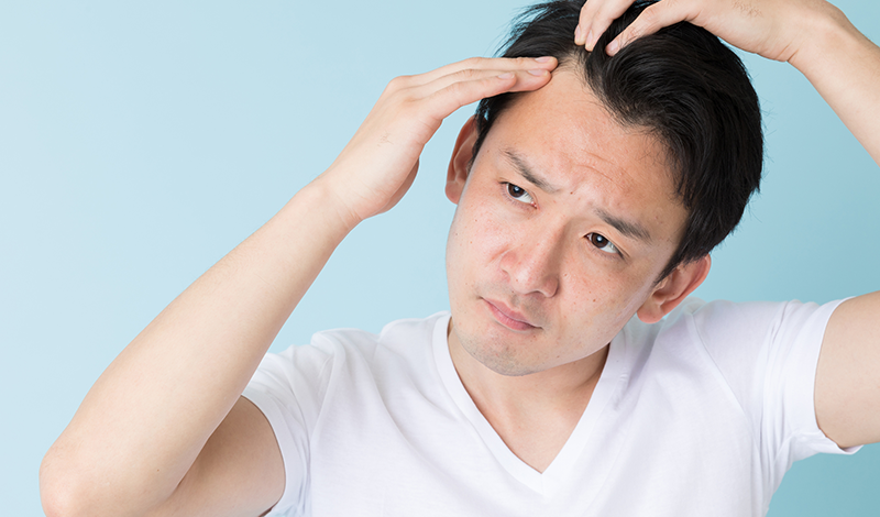 生え際を気にする男性