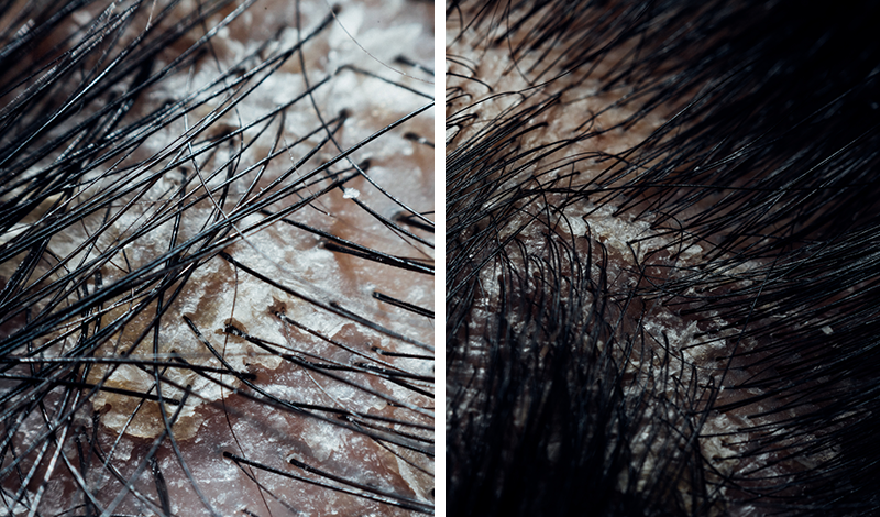 汚れた頭皮のアップ