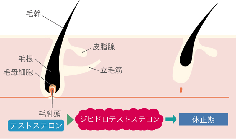 髪の毛と頭皮の断面図、毛幹、皮脂腺、毛根、毛母細胞、毛乳頭、立毛筋、テストステロン、ジヒドロテストステロン、休止期