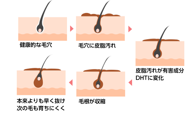 毛穴の汚れにより、抜け落ちるメカニズム