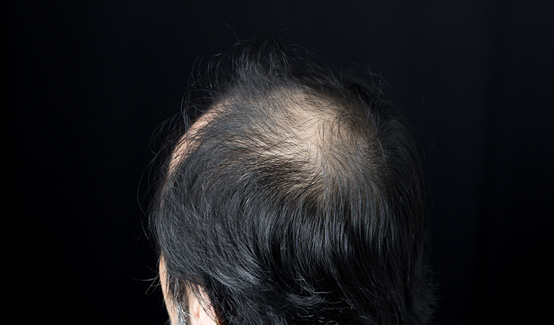 薄毛の頭頂部