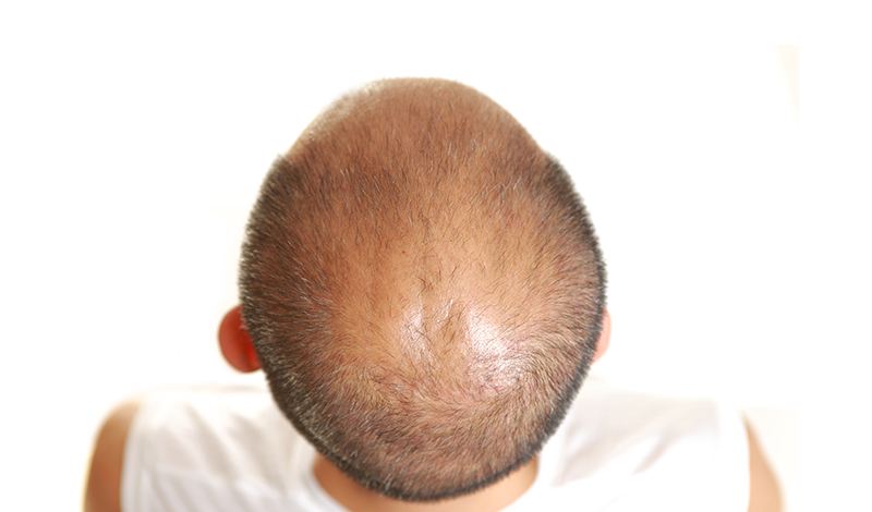 薄毛の頭頂部