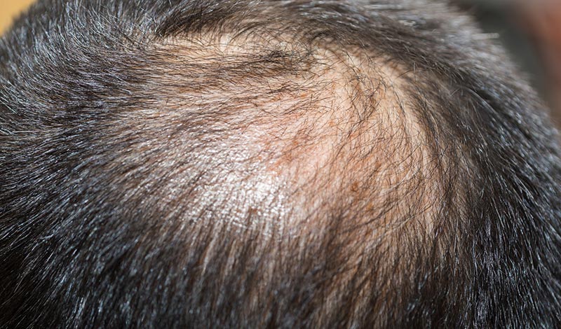 薄毛の頭頂部