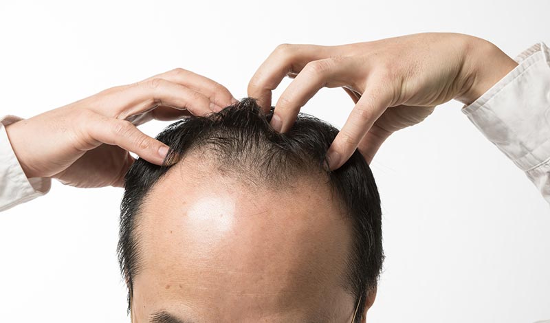薄くなった頭髪を触る