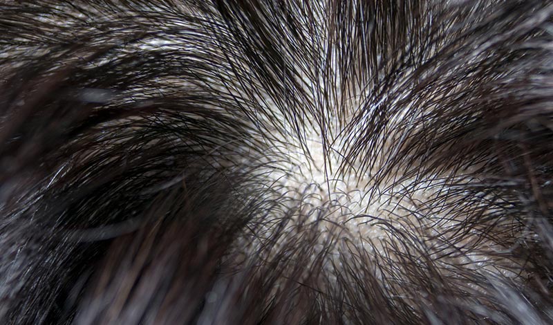 その薄毛諦めてませんか つむじの薄毛を今日で解消 髪コト 頭髪を通じてライフスタイルを豊かにするための情報を発信