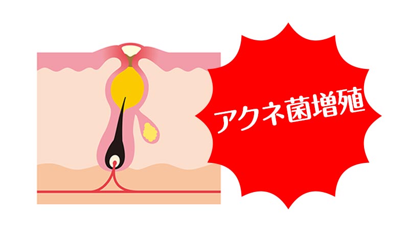 アクネ菌の増殖