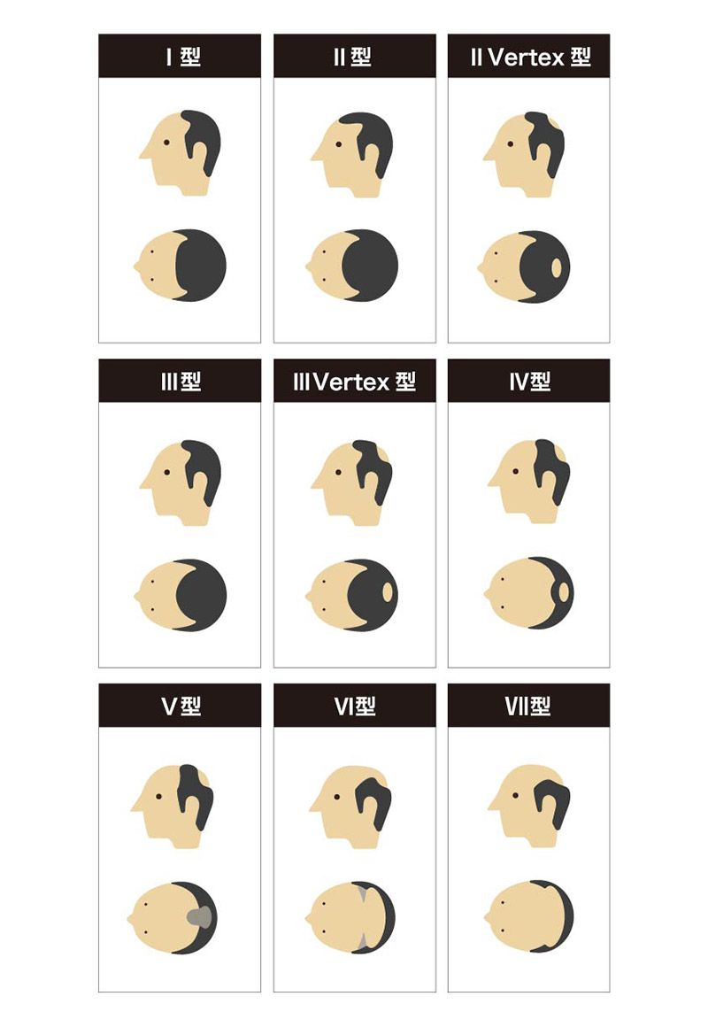 ハミルトン・ノーウッド分類と高島分類