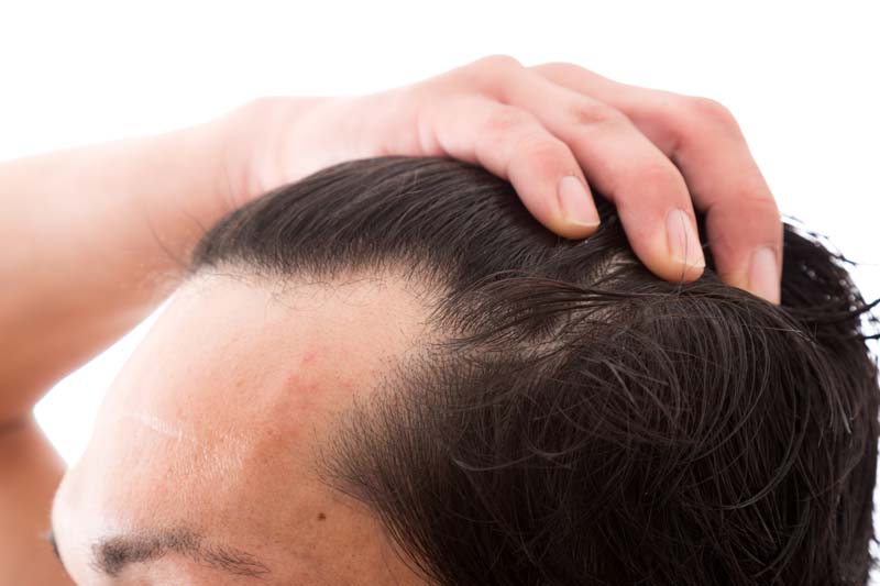 男性の生え際