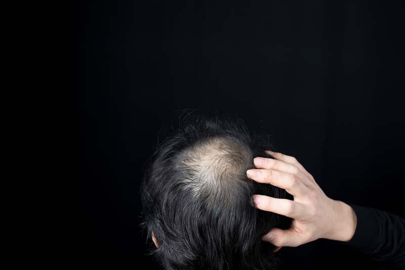 薄くなった頭頂部をさわる男性