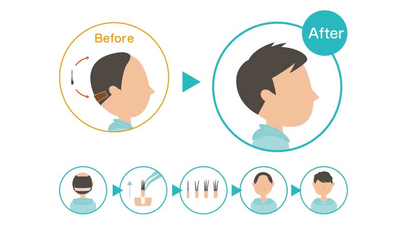 植毛の方法 イメージイラスト