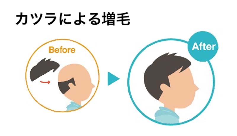 カツラによる増毛 イメージイラスト