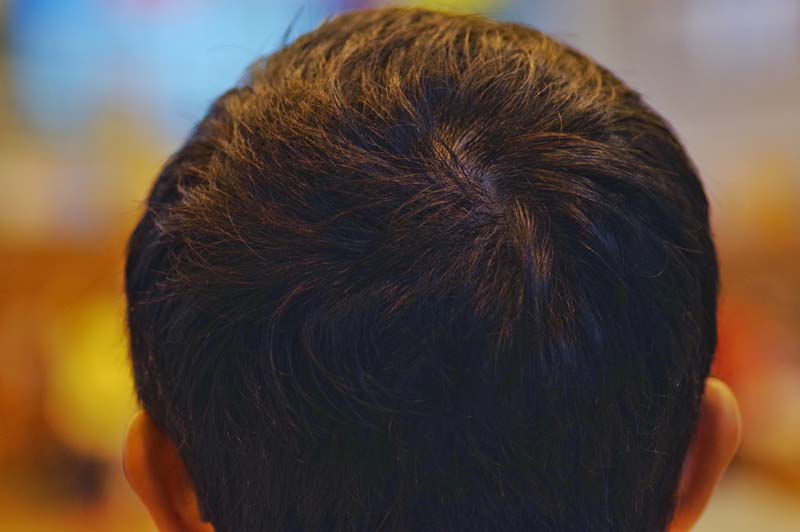 監修記事 つむじが薄いと感じる方必見 症状別の対策方法まとめ 髪コト 頭髪を通じてライフスタイルを豊かにするための情報を発信