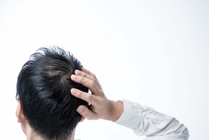 監修記事 つむじが薄いと感じる方必見 症状別の対策方法まとめ 髪コト 頭髪を通じてライフスタイルを豊かにするための情報を発信 監修記事 つむじが薄いと感じる方必見 症状別の対策方法まとめ 髪コト 頭髪を通じてライフスタイルを豊かにするための情報を発信