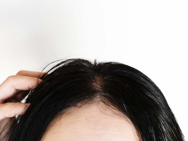 男性の薄毛 抜け毛の原因は 髪が生える基礎知識とセルフチェック法 髪コト 頭髪を通じてライフスタイルを豊かにするための情報を発信