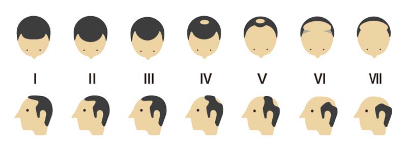 ハミルトン・ノーウッド分類と高島分類の複合モデル図