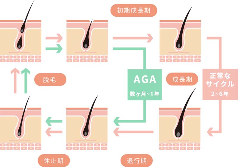 正常なヘアサイクルとAGA（男性型脱毛症）の場合のヘアサイクルの比較図