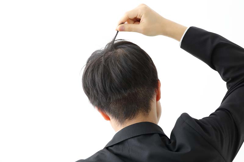 薄毛で頭頂部の髪を気にする男性