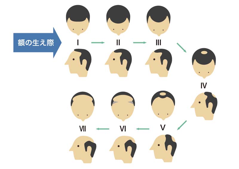 気になるm字ハゲ 育毛剤はm字の薄毛に効果があるのかを解説 髪コト 頭髪を通じてライフスタイルを豊かにするための情報を発信