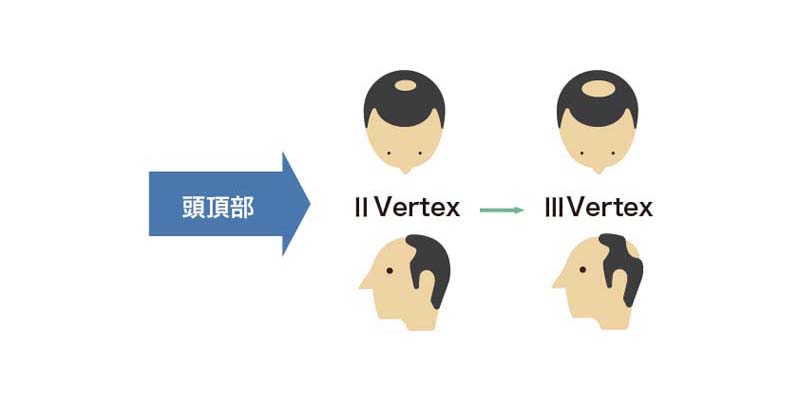 気になるつむじはげの正体は何 原因と解決法をレクチャー 髪コト 頭髪を通じてライフスタイルを豊かにするための情報を発信