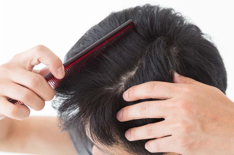 髪の分け目で目立つハゲの原因は何 男女別の対処法を解説 髪コト 頭髪を通じてライフスタイルを豊かにするための情報を発信
