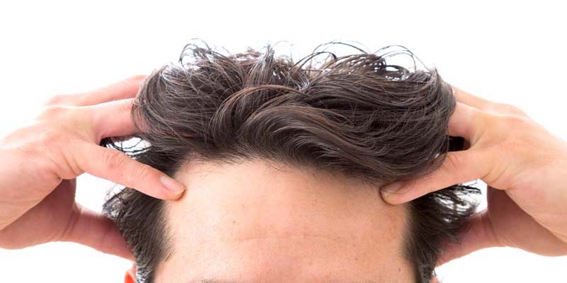 監修記事 M字ハゲってどういう状態のこと 原因や対処法を解説 髪コト 頭髪を通じてライフスタイルを豊かにするための情報を発信
