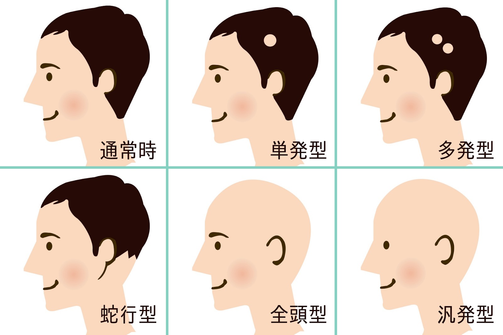 せい 円形 症 はんぱつ 脱毛 【専門医監修】円形脱毛症の発症の原因は？｜円形脱毛症でお悩みの方へ