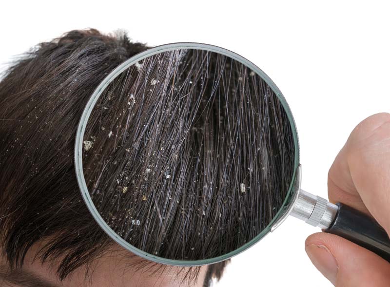 医師監修 シャンプーで薄毛対策 効果はある 選び方から洗い方まで 髪コト 頭髪を通じてライフスタイルを豊かにするための情報を発信