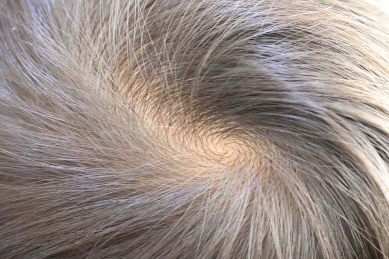つむじはげはどこから 専門家の視点 世間の声 髪コト 頭髪を通じてライフスタイルを豊かにするための情報を発信