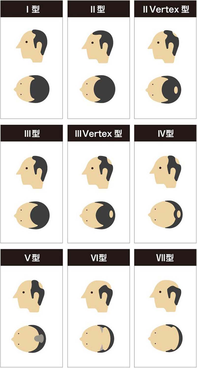 ハミルトン・ノーウッド分類のイメージイラスト