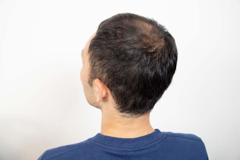 Agaによる薄毛は治るの Aga治療方法や効果について 髪コト 頭髪を通じてライフスタイルを豊かにするための情報を発信