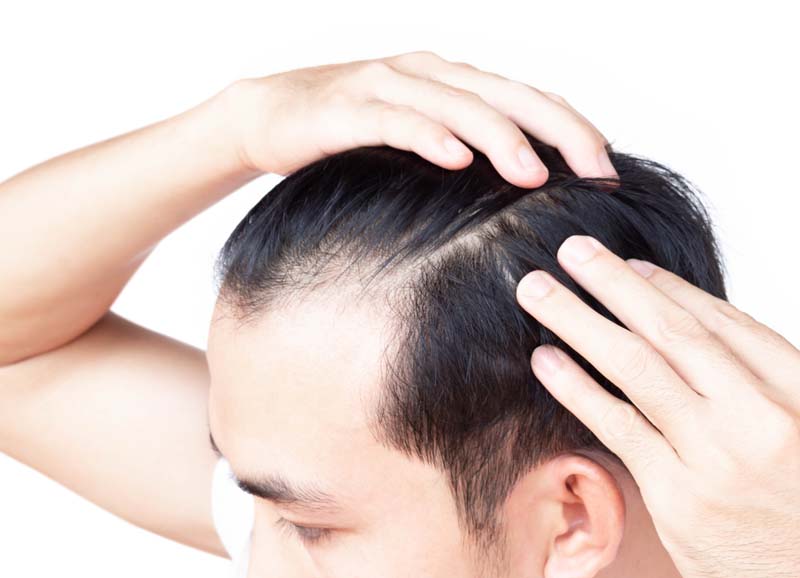 Agaによる薄毛は治るの Aga治療方法や効果について 髪コト 頭髪を通じてライフスタイルを豊かにするための情報を発信