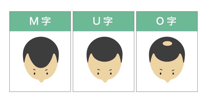 薄毛の3タイプのイメージイラスト（M字・U字・O字）