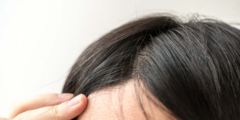 監修記事 生え際の後退は発毛が難しい 改善する可能性について 髪コト 頭髪を通じてライフスタイルを豊かにするための情報を発信