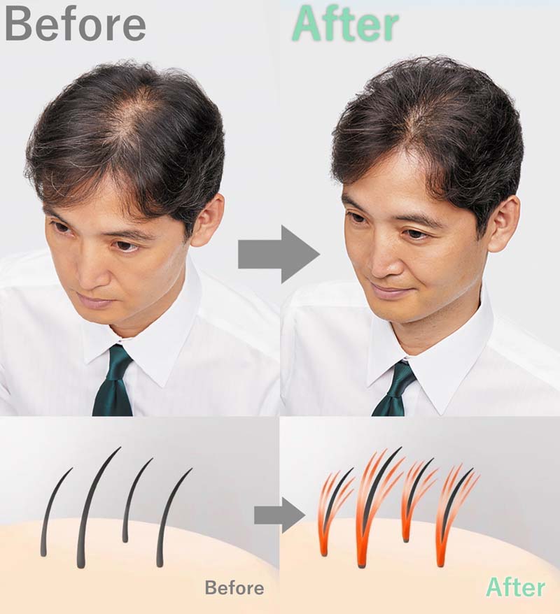 スヴェンソンの増毛(マイヘアプラス)によるビフォーアフター写真と結毛のイメージイラスト