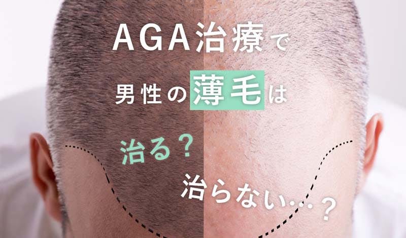 AGA治療では男性の薄毛は治らない？～アンケート調査で分かった現実