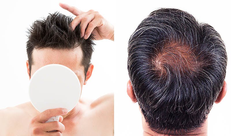 男性の薄毛の特徴と治療方法