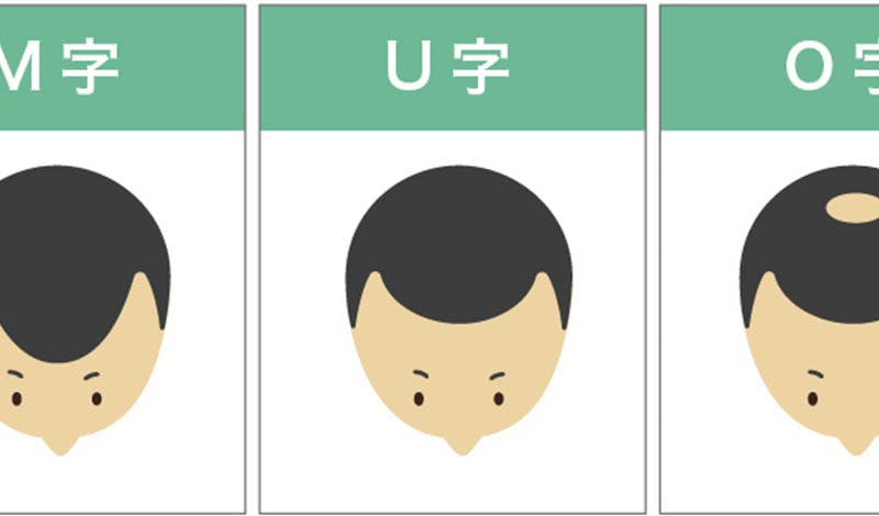 あなたの生え際はどの形 薄毛タイプから見る対策方法のススメ 髪コト 頭髪を通じてライフスタイルを豊かにするための情報を発信