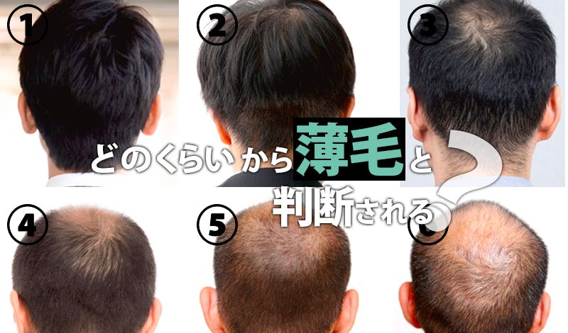監修記事 つむじが薄いと感じる方必見 症状別の対策方法まとめ 髪コト 頭髪を通じてライフスタイルを豊かにするための情報を発信 監修記事 つむじが薄いと感じる方必見 症状別の対策方法まとめ 髪コト 頭髪を通じてライフスタイルを豊かにするための情報を発信