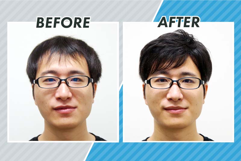 スヴェンソンの編み込み式増毛によるコクブさんのビフォーアフター写真（正面）