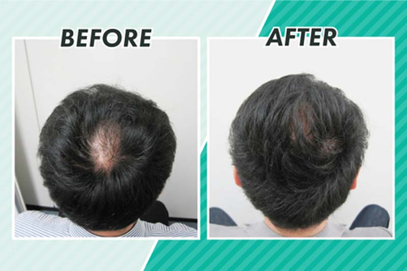 スヴェンソンのヘアカットによるビフォーアフター写真1(頭頂部)