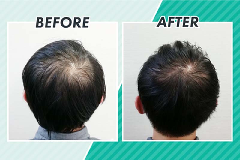 スヴェンソンのヘアカットによるビフォーアフター写真2(頭頂部)